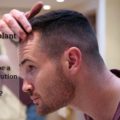 Hair Transplant – Would this be a permanent solution to hair loss!?